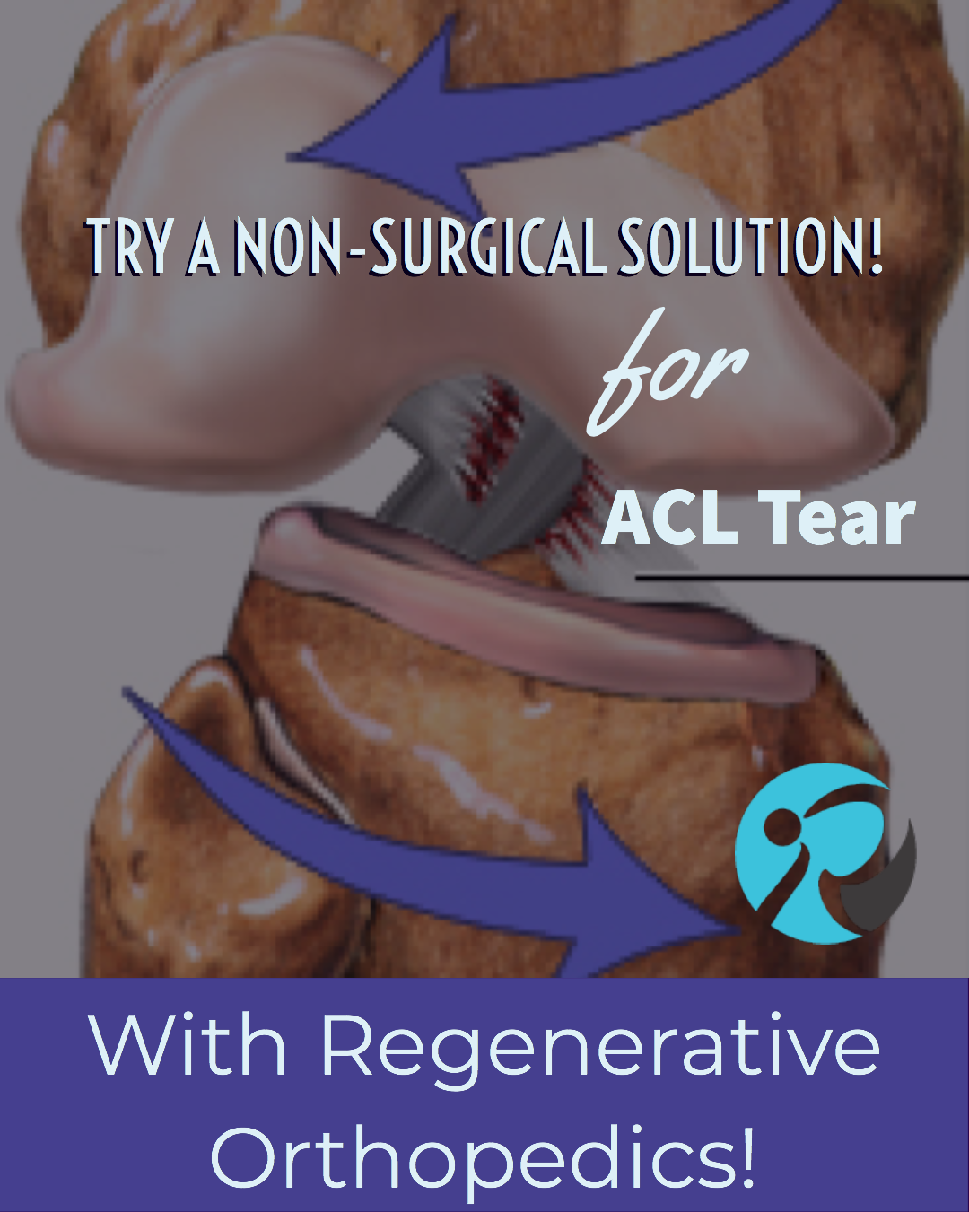 ACL Tears Can Be Repaired (Sometimes) – Nirschl Orthopaedic Center