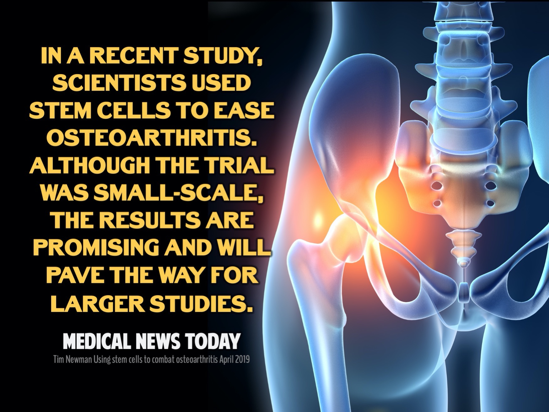 Stem Cell Therapy for Arthritis - Peter A. Fields, MD, DC