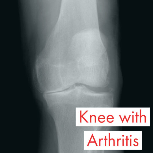 Get Rid Of Knee Arthritis Symptoms By Treating The Source Of The Pain